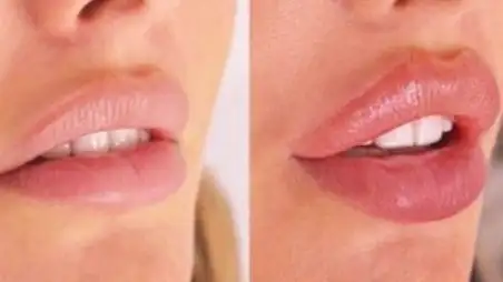 راهنمای جامع تزریق ژل لب؛ چگونه لب‌هایی خوش‌فرم، طبیعی داشته باشیم؟